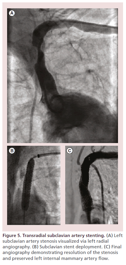 interventional-cardiology-Transradial-subclavian