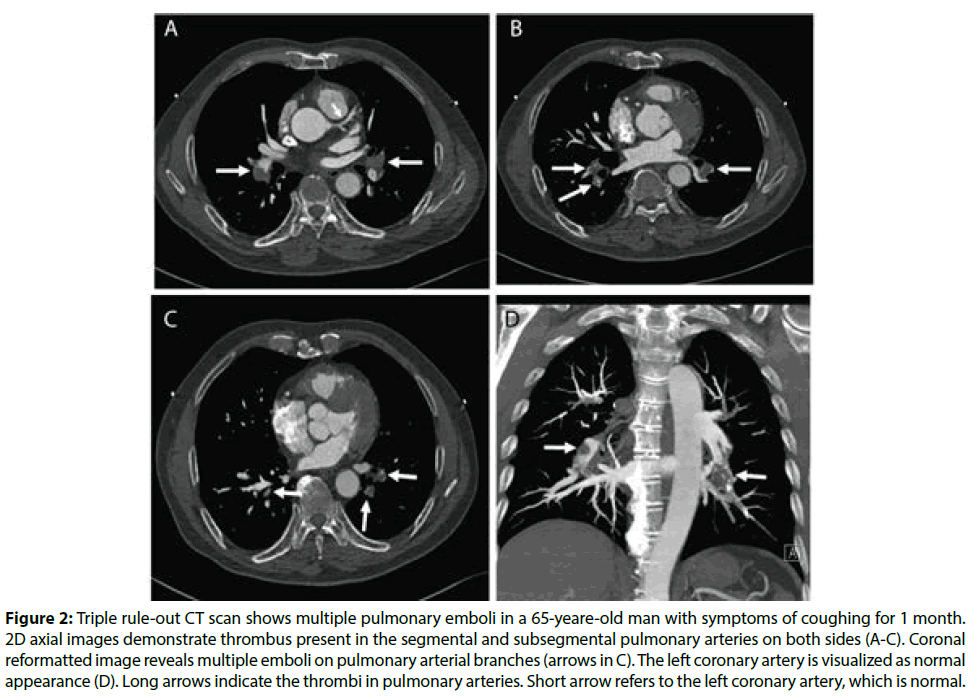 interventional-cardiology-Triple-rule