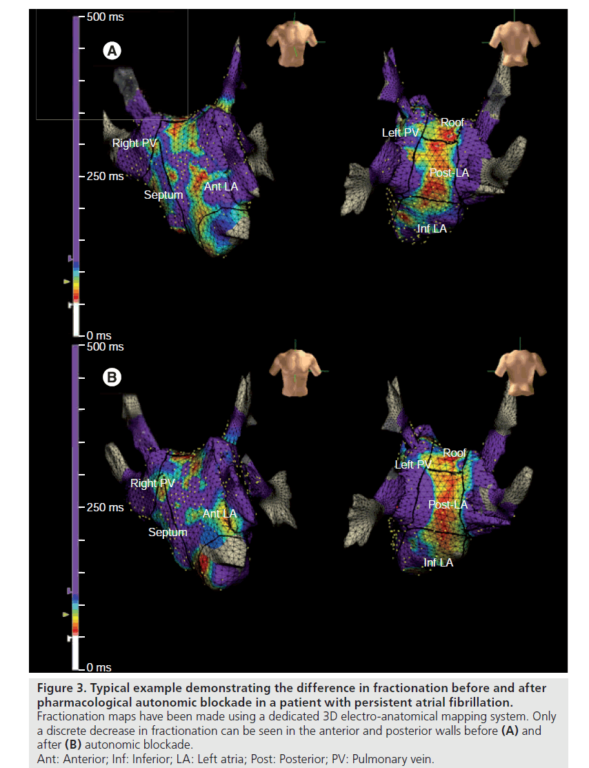 interventional-cardiology-Typical-example