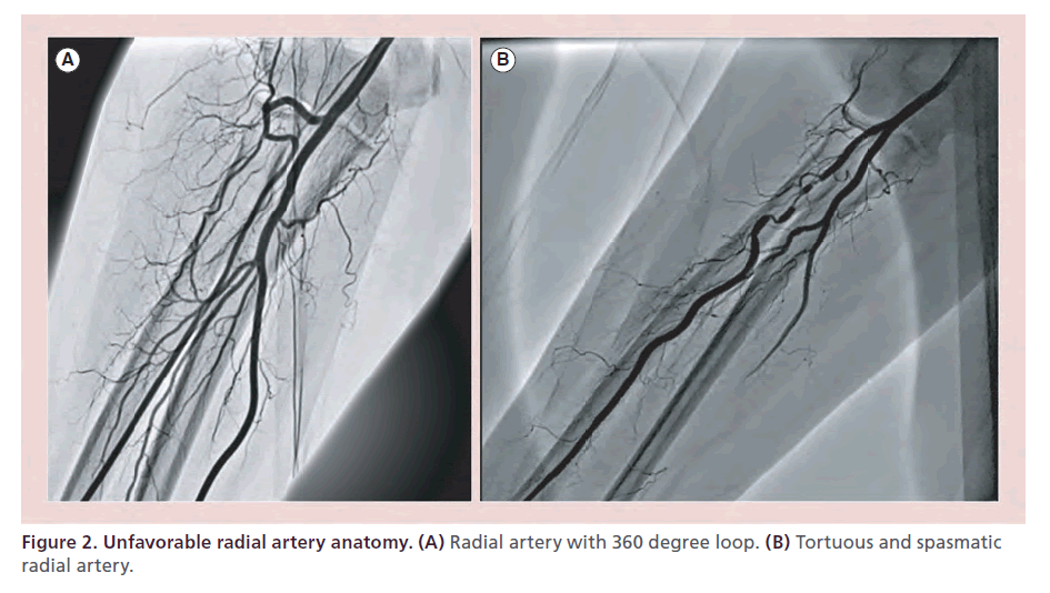 interventional-cardiology-Unfavorable-radial