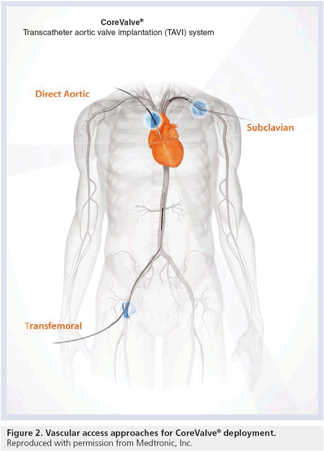 interventional-cardiology-Vascular-access-approaches