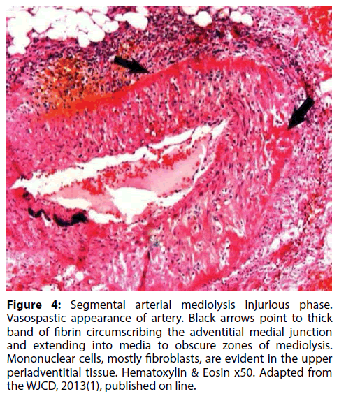 interventional-cardiology-Vasospastic-appearance