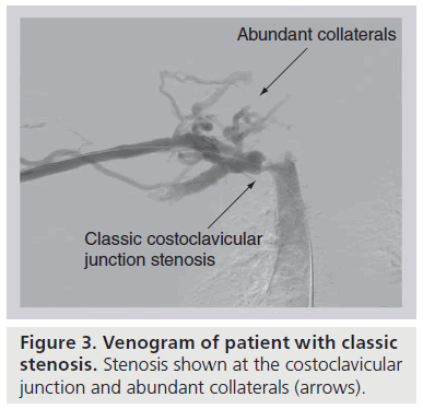 interventional-cardiology-Venogram