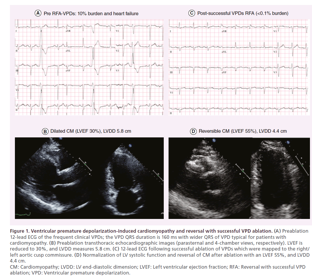 interventional-cardiology-Ventricular-premature