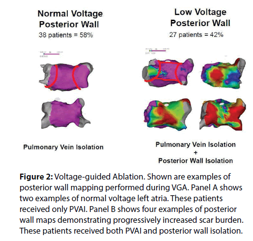 interventional-cardiology-Voltage-guided-Ablation