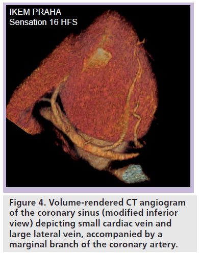 interventional-cardiology-Volume-rendered