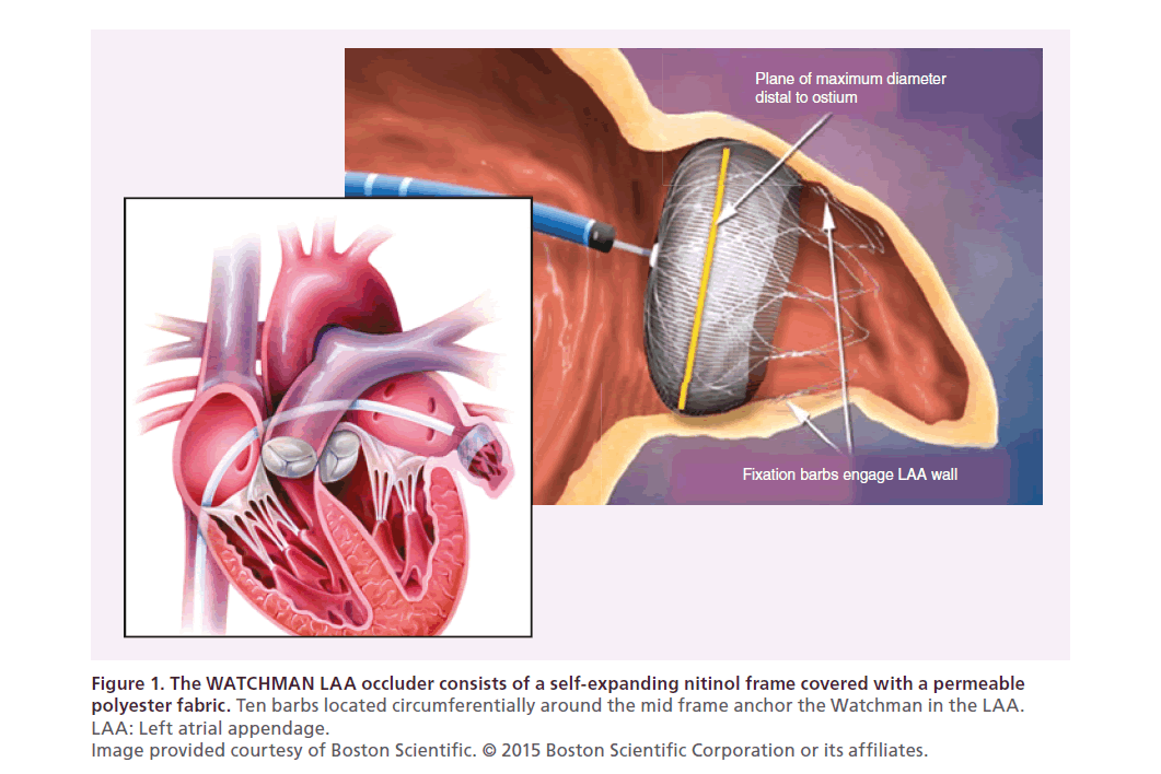 interventional-cardiology-WATCHMAN-LAA