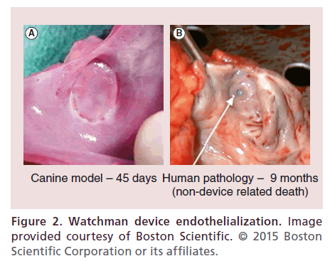 interventional-cardiology-Watchman-device