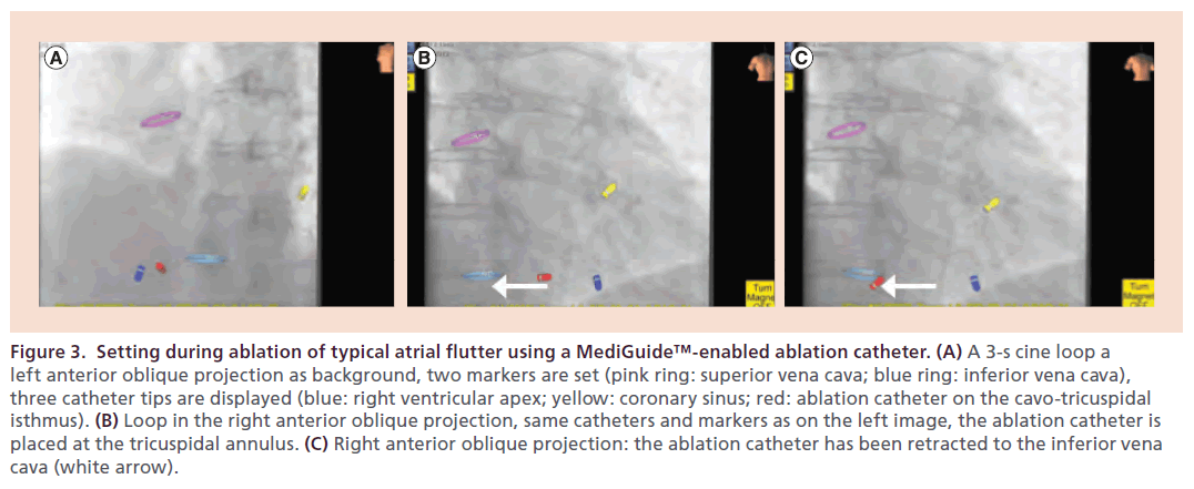 interventional-cardiology-ablation-catheter
