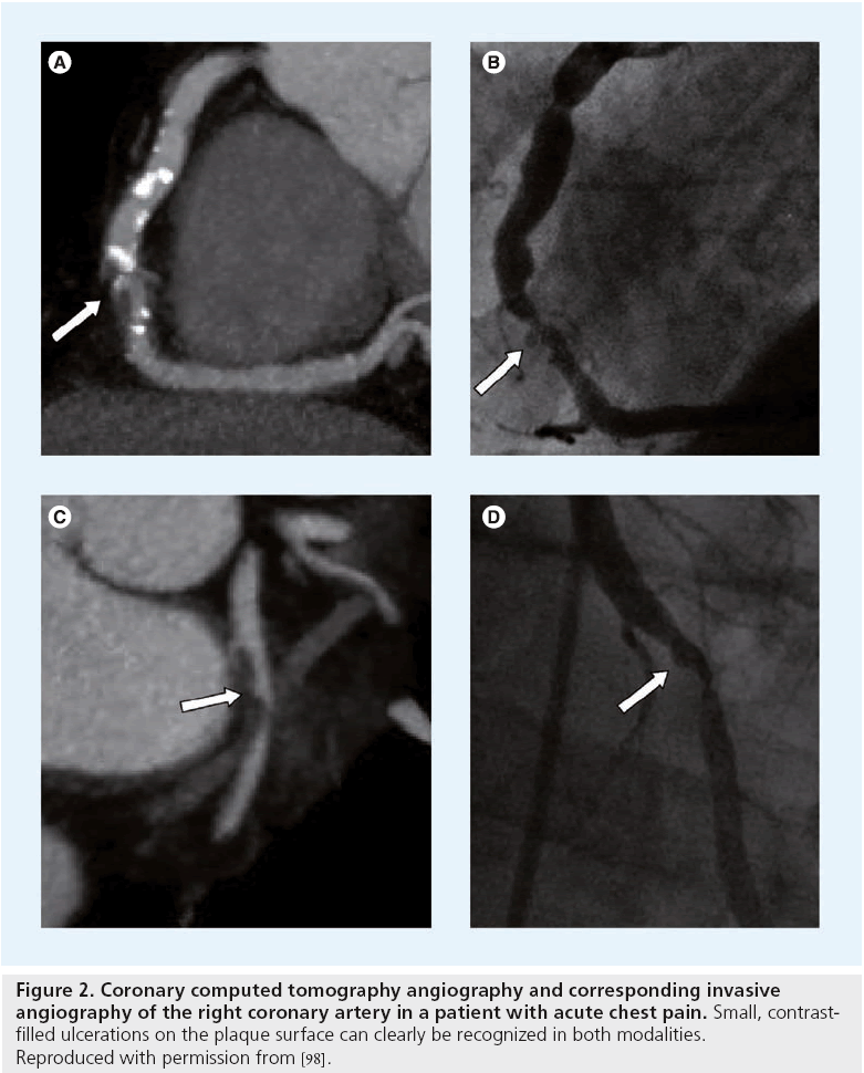 interventional-cardiology-acute-chest-pain