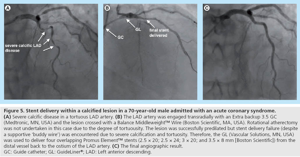 interventional-cardiology-acute-coronary-syndrome