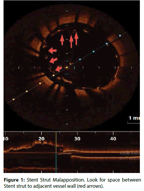 interventional-cardiology-adjacent-vessel