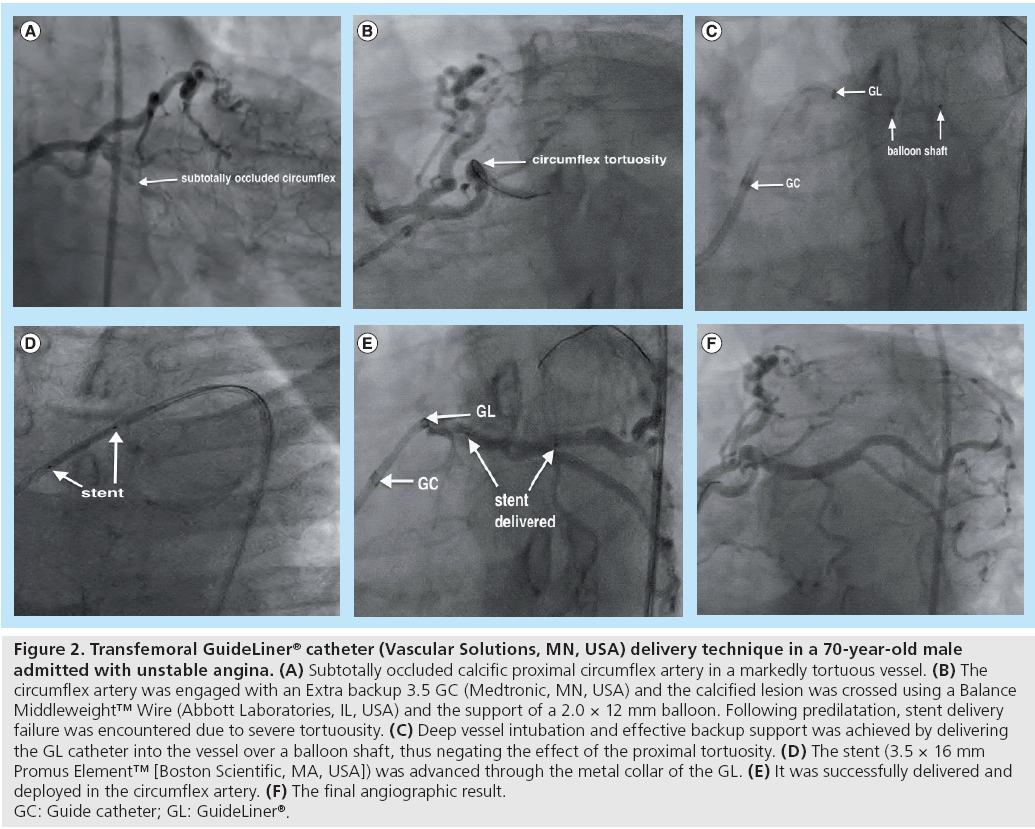 interventional-cardiology-admitted-unstable-angina