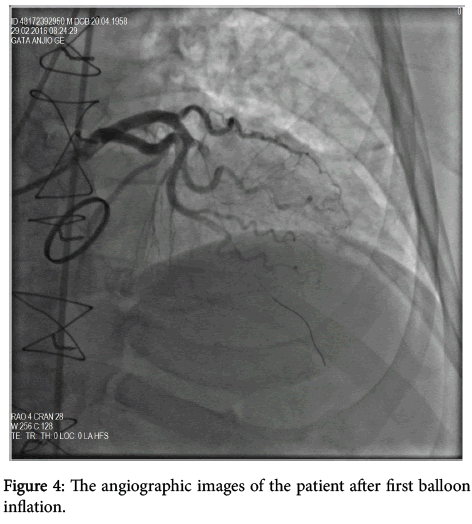 interventional-cardiology-after-balloon-inflation