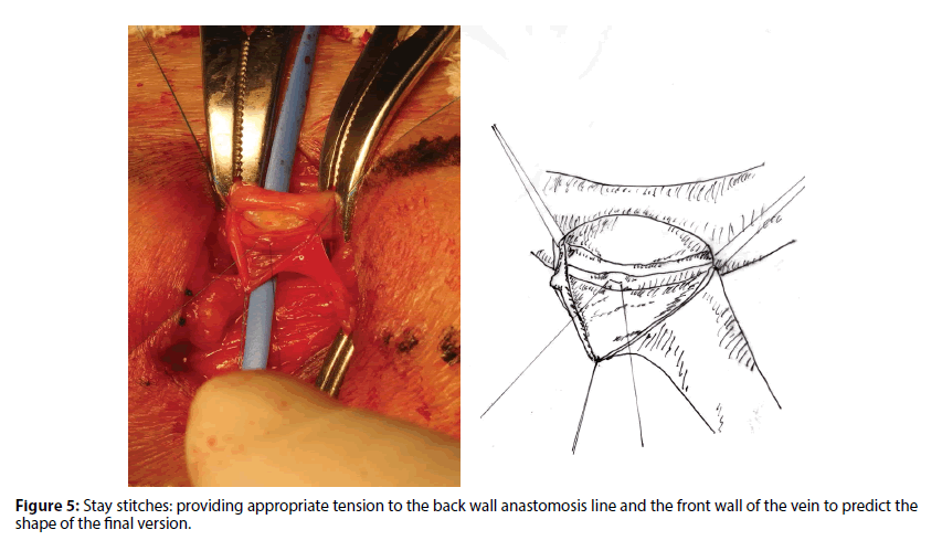 interventional-cardiology-anastomosis-line