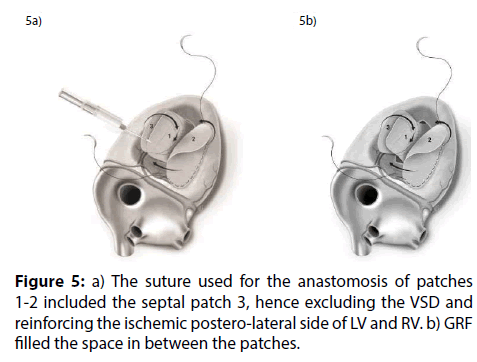 interventional-cardiology-anastomosis-patches