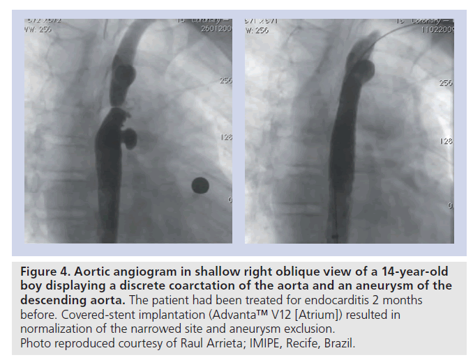 interventional-cardiology-aneurysm-exclusion