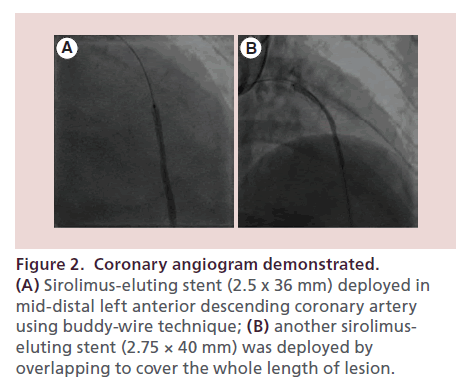 interventional-cardiology-angiogram-demonstrated