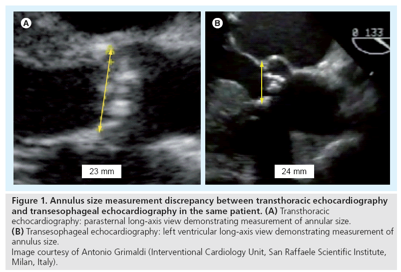 interventional-cardiology-annulus-size