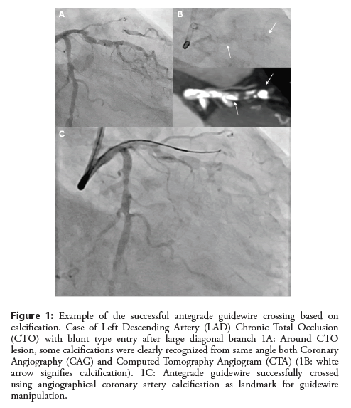 interventional-cardiology-antegrade