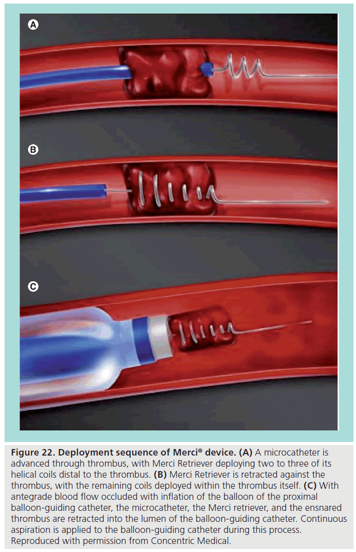 interventional-cardiology-antegrade-blood-flow