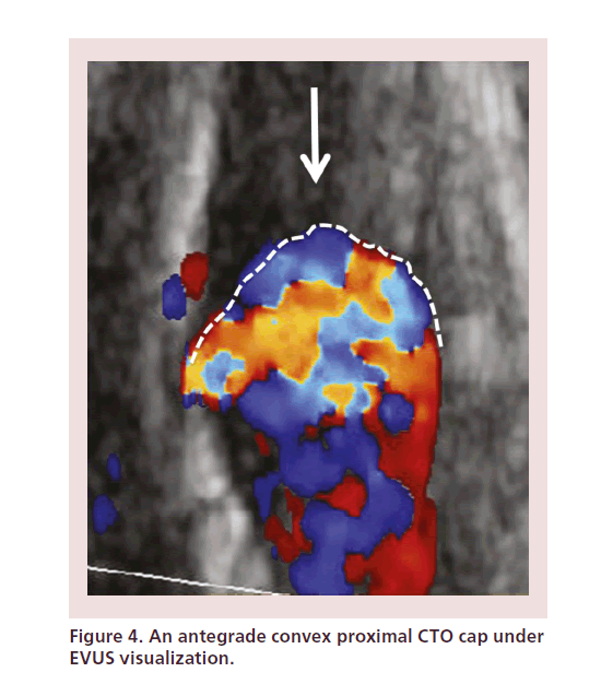 interventional-cardiology-antegrade-convex-proximal