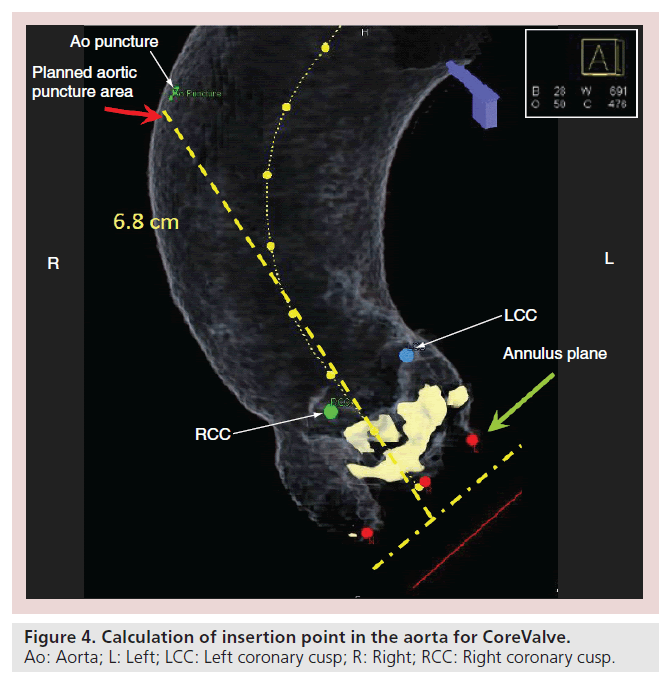 interventional-cardiology-aorta-CoreValve