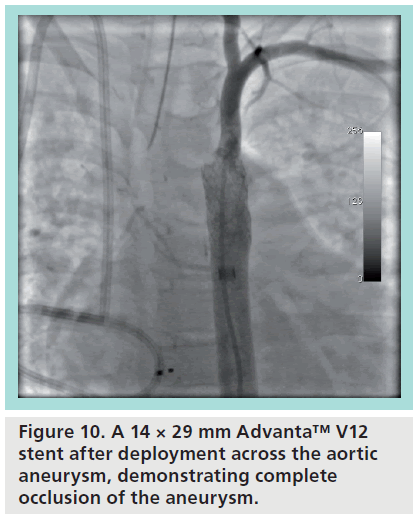 interventional-cardiology-aortic-aneurysm