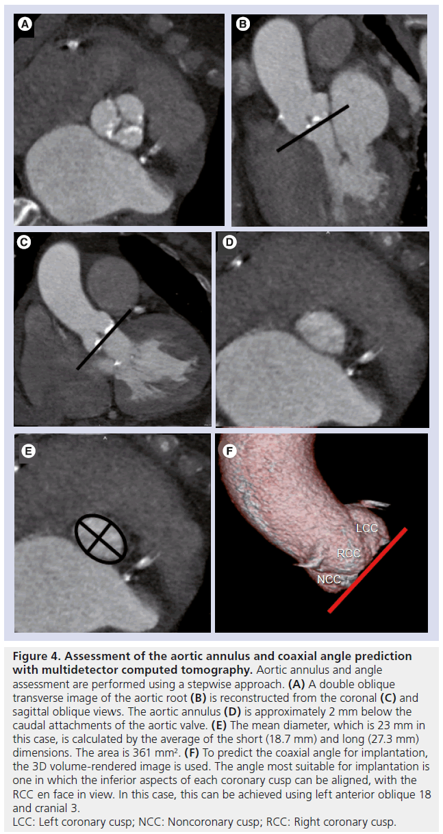 interventional-cardiology-aortic-annulus