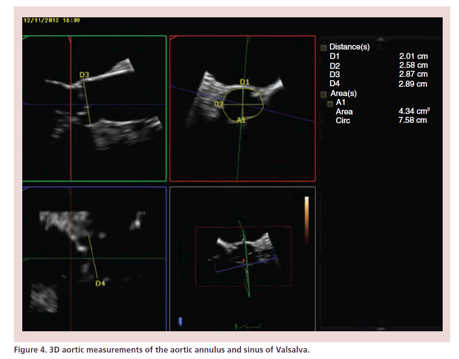 interventional-cardiology-aortic-annulus