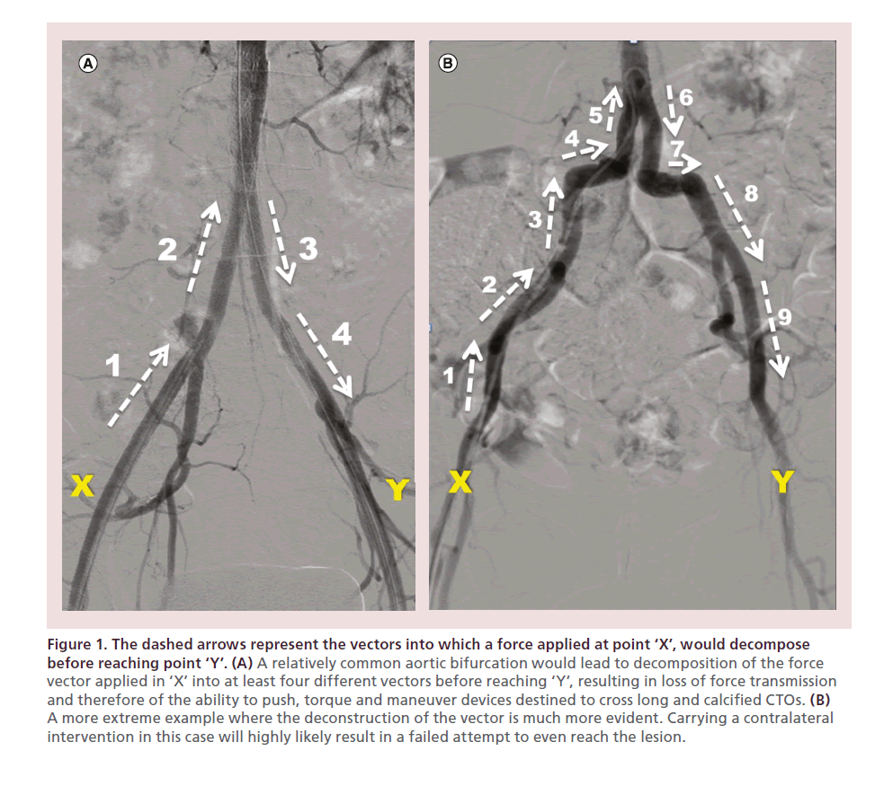 interventional-cardiology-aortic-bifurcation