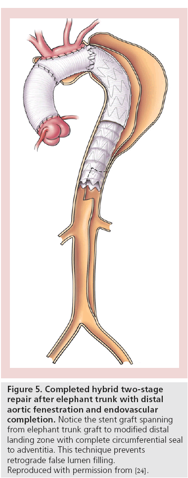 interventional-cardiology-aortic-fenestration-endovascular