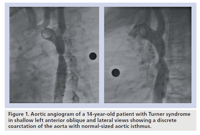 interventional-cardiology-aortic-isthmus