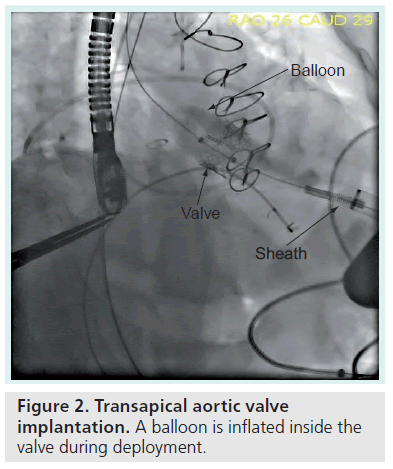 interventional-cardiology-aortic-valve