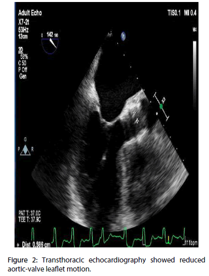 interventional-cardiology-aortic-valve