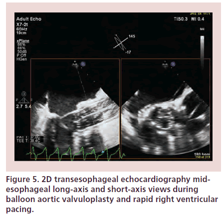 interventional-cardiology-aortic-valvuloplasty