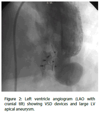 interventional-cardiology-apical-aneurysm