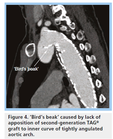 interventional-cardiology-apposition-second