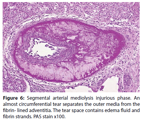 interventional-cardiology-arterial-mediolysis