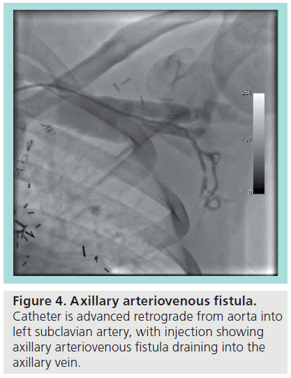 interventional-cardiology-arteriovenous-fistula