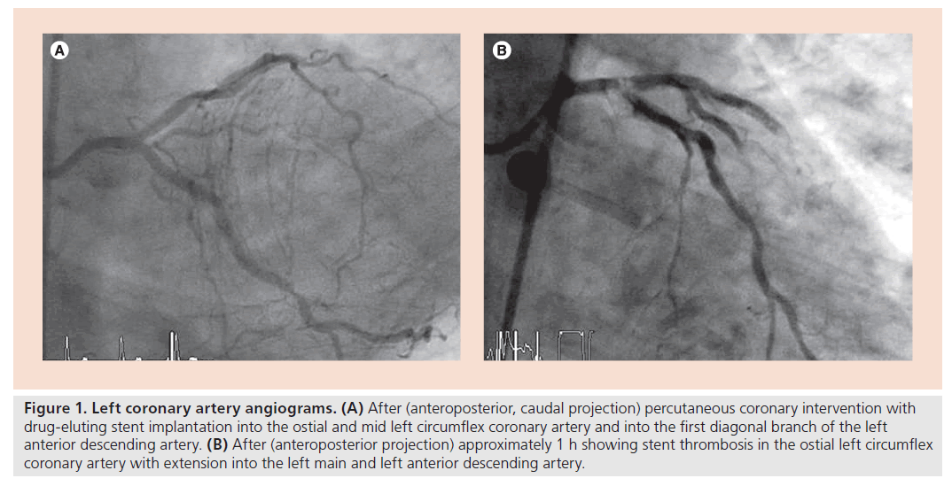 interventional-cardiology-artery-angiograms