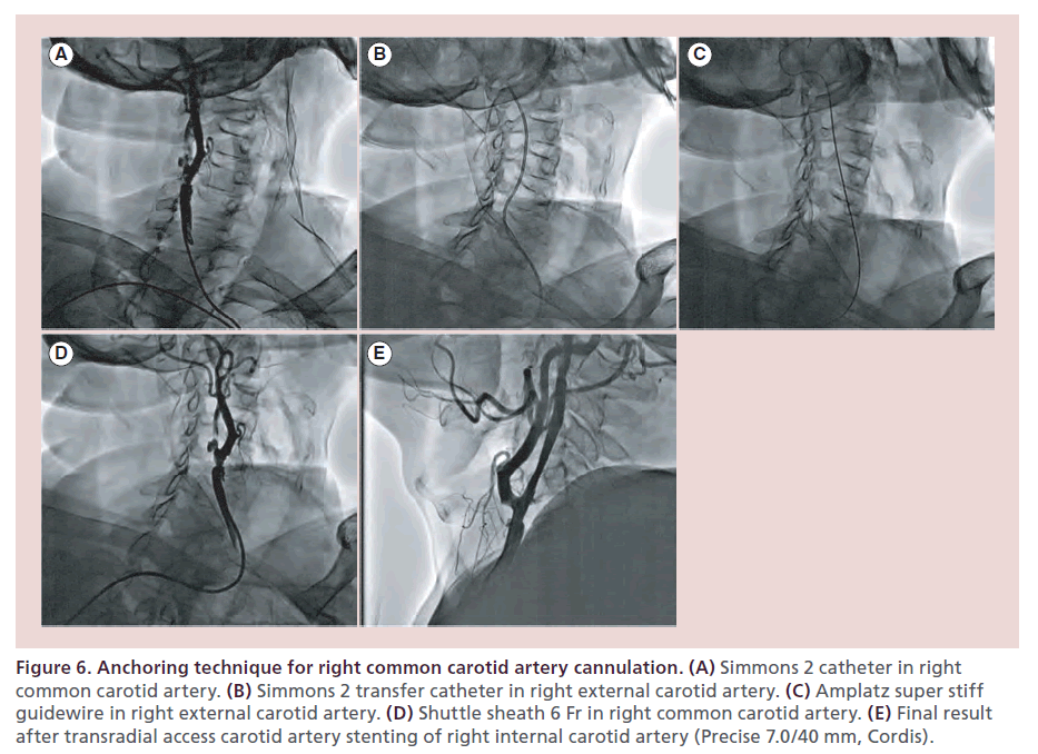 interventional-cardiology-artery-cannulation