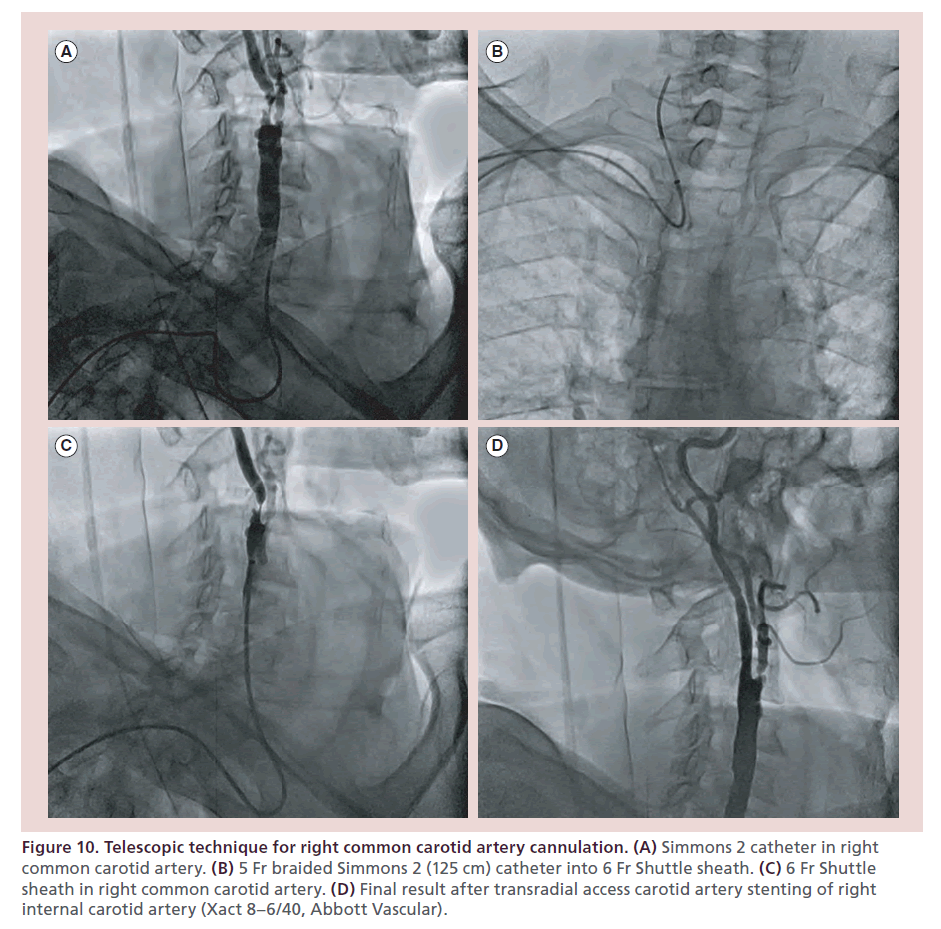 interventional-cardiology-artery-cannulation