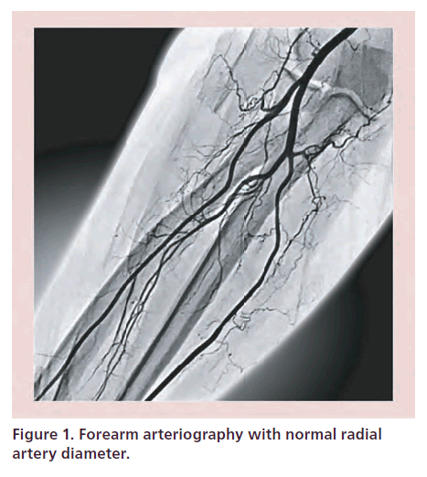 interventional-cardiology-artery-diameter