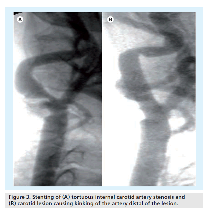 interventional-cardiology-artery-stenosis