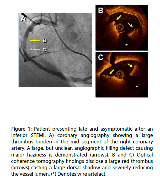 interventional-cardiology-asymptomatic