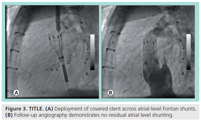 interventional-cardiology-atrial-level-Fontan