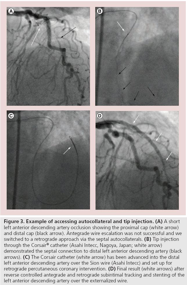 interventional-cardiology-autocollateral-tip-injection