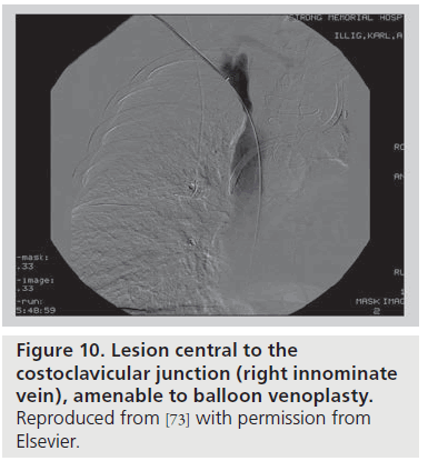 interventional-cardiology-balloon