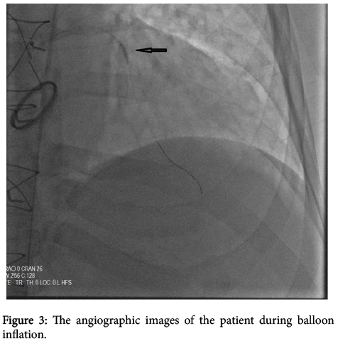 interventional-cardiology-balloon-inflation